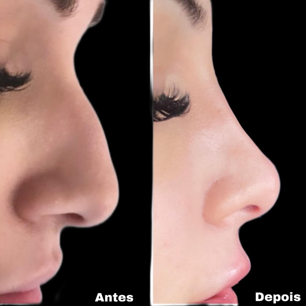Antes e depois — harmonização facial