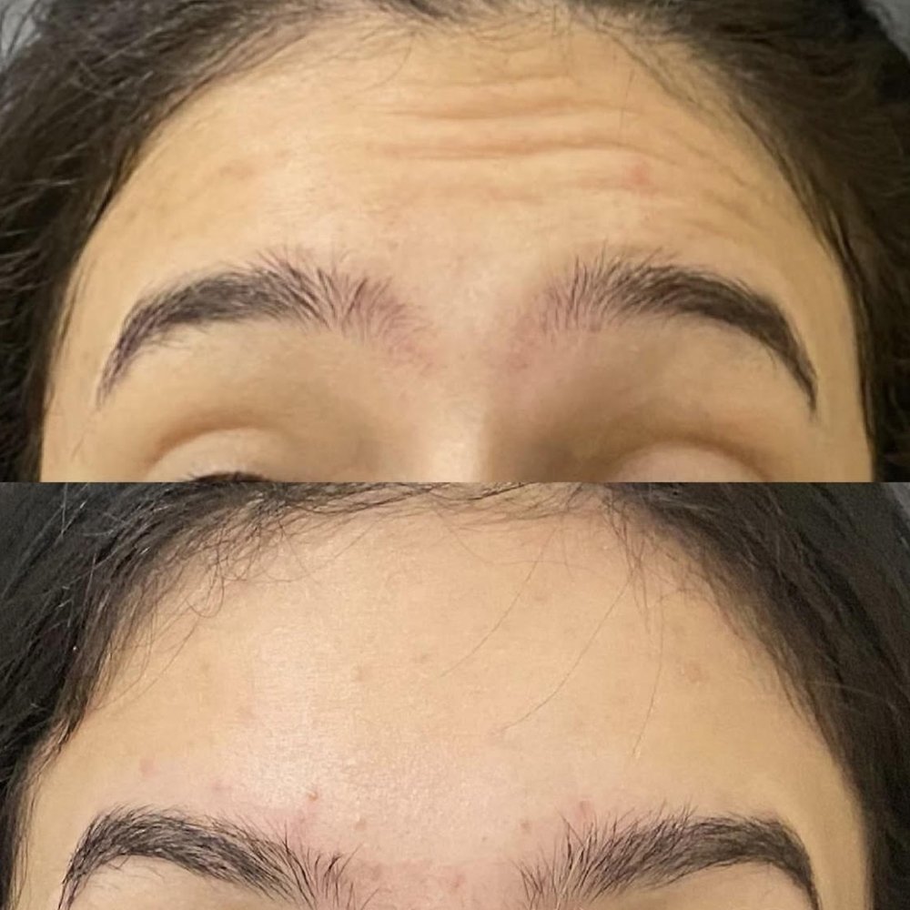 Antes e depois — preenchimento labial