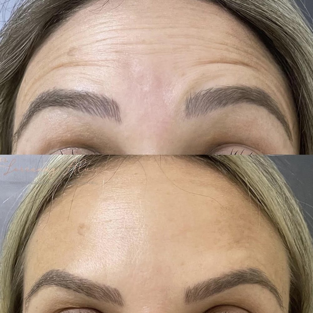 Antes e depois — rinomodelação