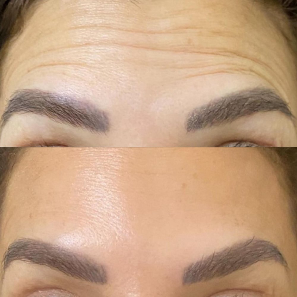 Antes e depois — contorno de mandíbula